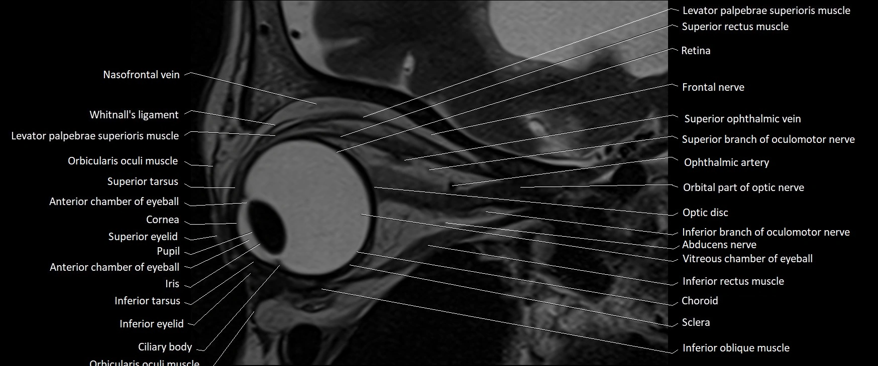 MRI Orbit sagittal cross sectional anatomy 3T image 9.webp